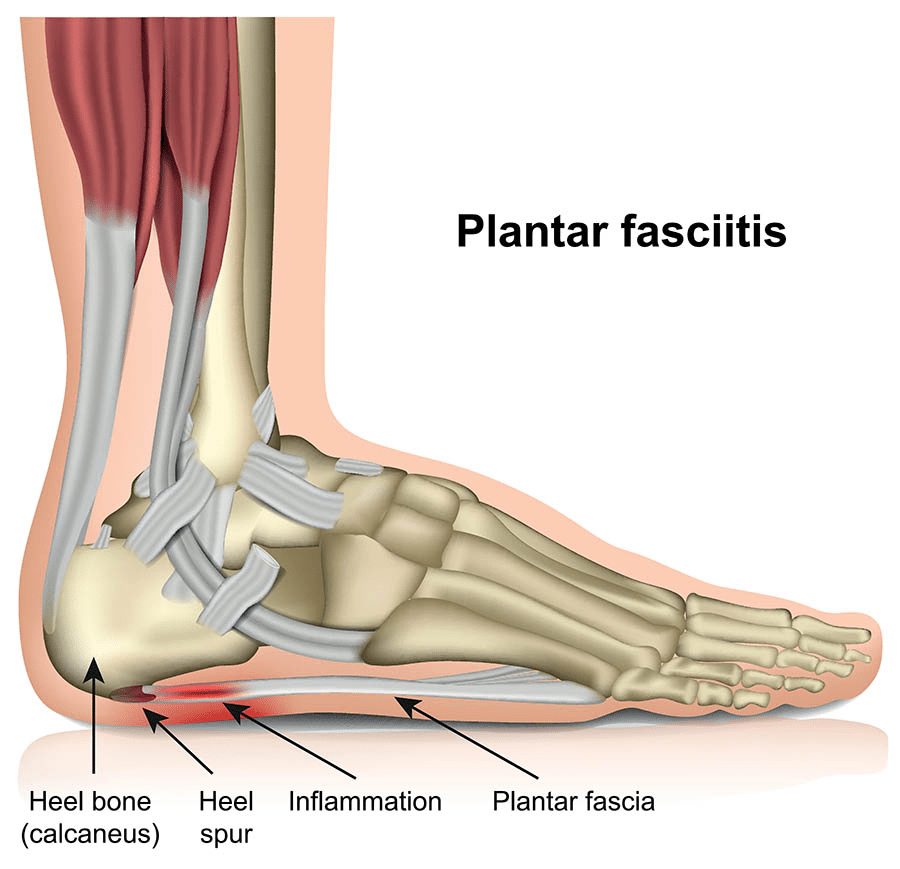 A view of the origin of plantar fasciitis inside the foot bone